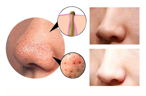 4-in-1 Facial Pore Vacuum & Body Cupping Therapy Device